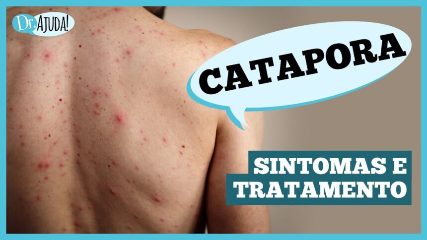 Catapora: sintomas, complicações e prevenção