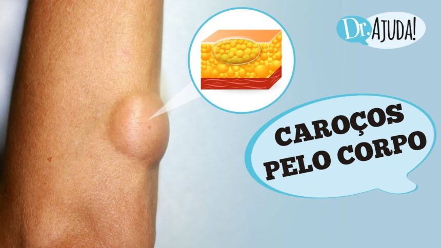 Caroços pelo corpo e lipoma: O que são? O que reparar?